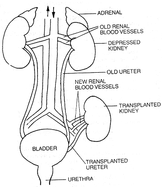 1730_kidney transplantation.png